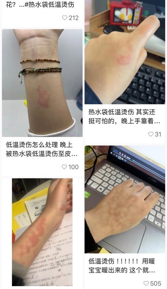 益丰配资 烫“掉皮”却没知觉，使用取暖用品谨防低温烫伤